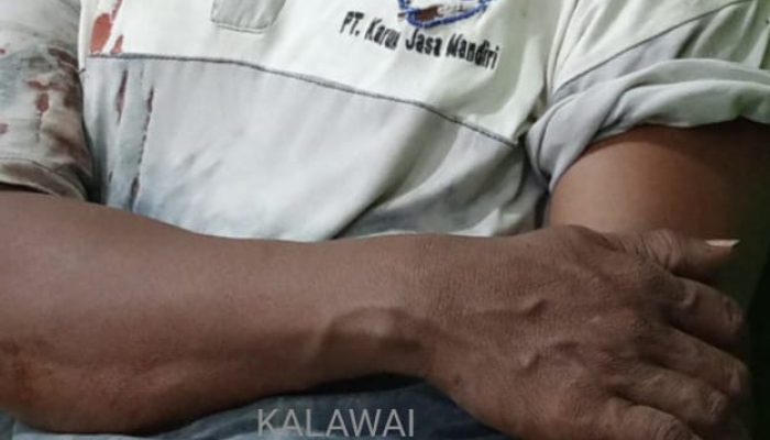 Patah Tulang dan Luka Jahit, Sopir Truk Kontainer Diperdaya OTK Salah Sasaran