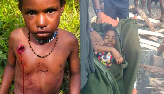 Sempat Dirawat 36 Hari, Aliko Walia, Anak 7 Tahun Korban Operasi Militer di Puncak Jaya, Meninggal Dunia