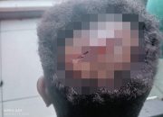 Korban Dugaan Janji Politik Mengaku Dikeroyok di Nabire, Kepala Luka 17 Jahitan
