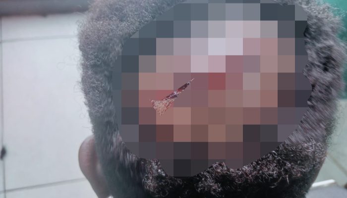 Korban Dugaan Janji Politik Mengaku Dikeroyok di Nabire, Kepala Luka 17 Jahitan