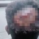 Korban Dugaan Janji Politik Mengaku Dikeroyok di Nabire, Kepala Luka 17 Jahitan