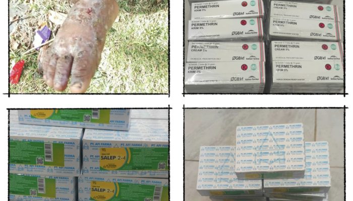 Kasus Skabies Meluas hingga Berkomplikasi Pioderma, Dinkes Papua Tengah Pastikan Obat dan Tim Medis Tetap Sampai ke Puncak Jaya